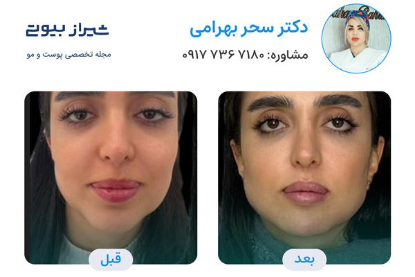 زاویه سازی صورت در شیراز - دکتر سحر بهرامی