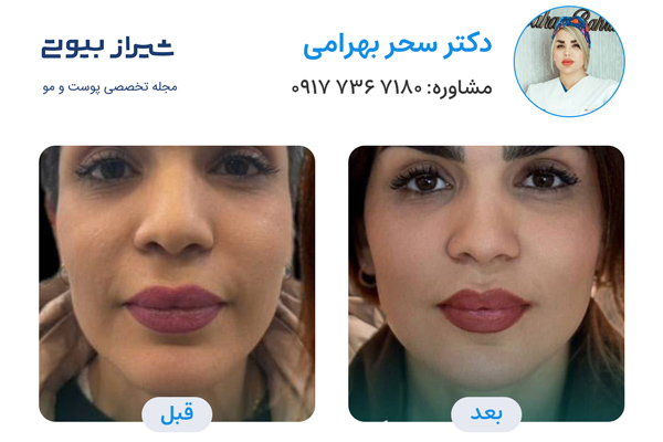 زاویه سازی صورت در شیراز - دکتر سحر بهرامی