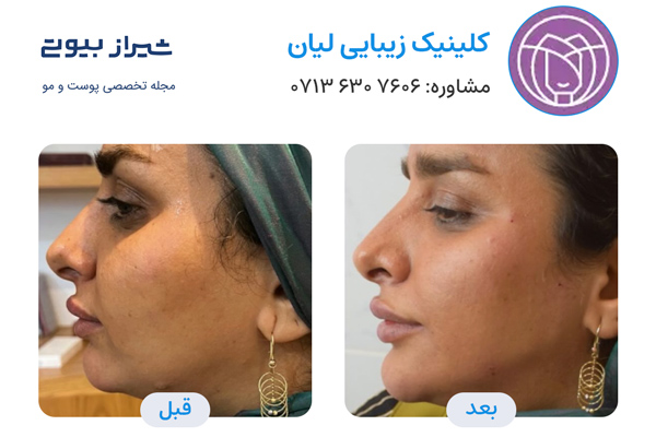 زاویه سازی صورت در شیراز - کلینیک لیان