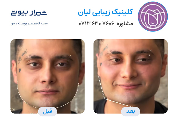 زاویه سازی صورت در شیراز - کلینیک لیان