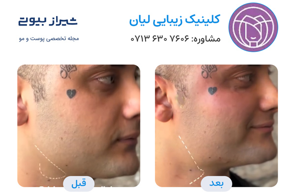 زاویه سازی صورت در شیراز - کلینیک لیان