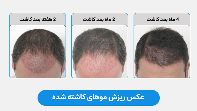 عکس ریزش موهای کاشته شده
