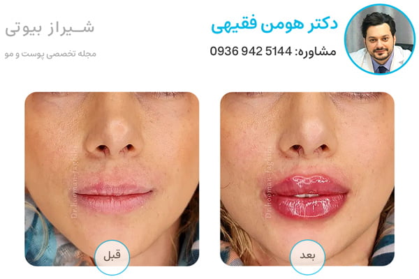 عکس قبل و بعد تزریق ژل لب در شیراز دکتر هومن فقیهی