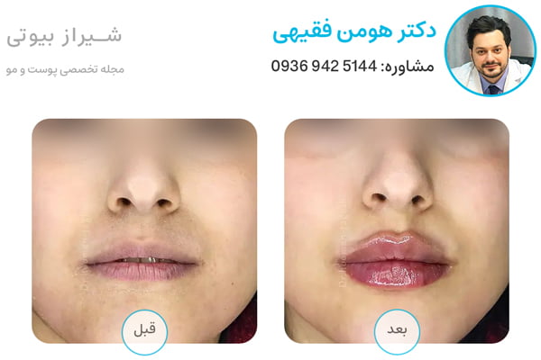 عکس قبل و بعد تزریق ژل لب در شیراز دکتر هومن فقیهی
