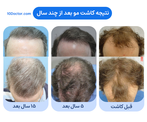 کاشت مو چند سال دوام دارد؟