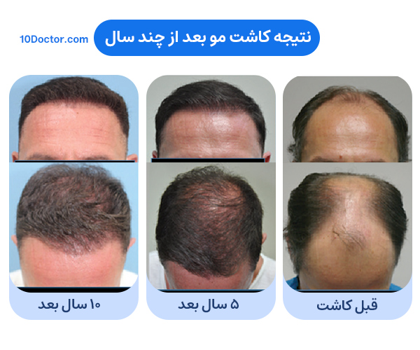 کاشت مو چند سال دوام دارد؟