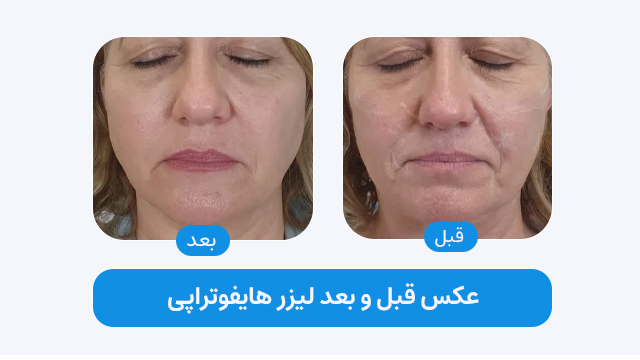 عکس قبل و بعد لیزر هایفو