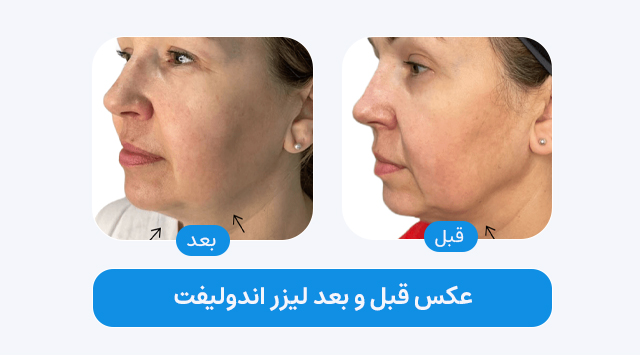 عکس قبل و بعد لیزر اندولیفت