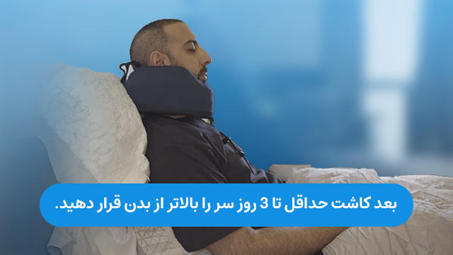 بعد کاشت مو حداقل تا 3 روز سر را بالاتر از سطح بدن قرار دهید.