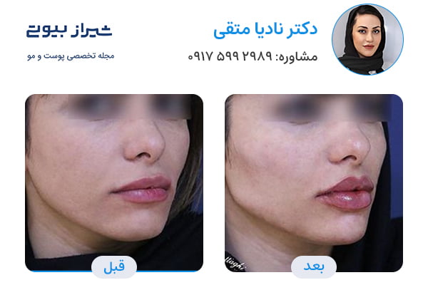 Gel injection in Shiraz Dr nadiya mottaghi case 2