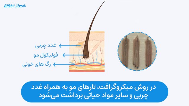 در روش میکروگرافت، تارهای مو به همراه غدد چربی و سایر موارد ضروری برای مو برداشت می‌شود.