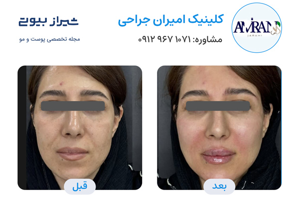 تزریق ژل در شیراز - کلینیک امیران جراحی