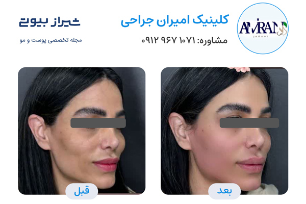 تزریق ژل در شیراز - کلینیک امیران جراحی