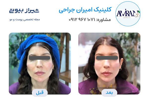 تزریق ژل در شیراز - کلینیک امیران جراحی