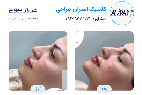 تزریق ژل در شیراز - کلینیک امیران جراحی