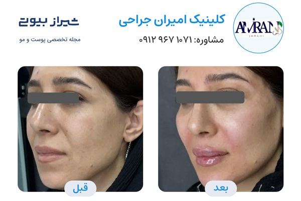 تزریق ژل در شیراز - کلینیک امیران جراحی