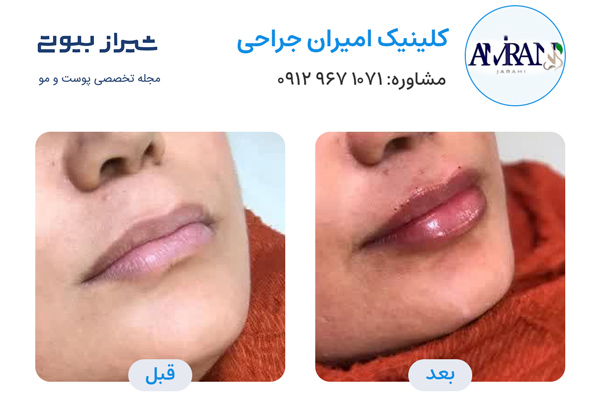 تزریق ژل در شیراز - کلینیک امیران جراحی