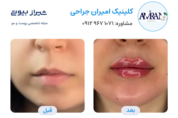 تزریق ژل در شیراز - کلینیک امیران جراحی