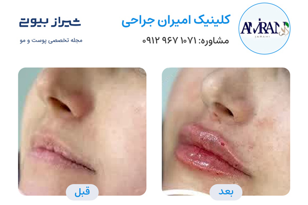 تزریق ژل در شیراز - کلینیک امیران جراحی