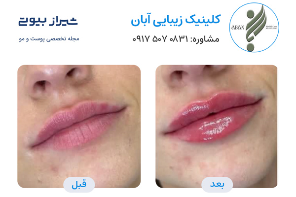 تزریق ژل در شیراز - کلینیک آبان