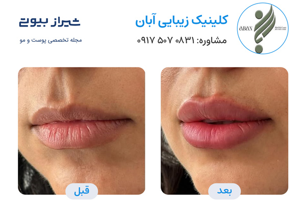 تزریق ژل در شیراز - کلینیک آبان