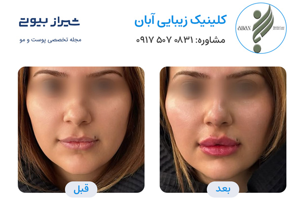 تزریق ژل در شیراز - کلینیک آبان