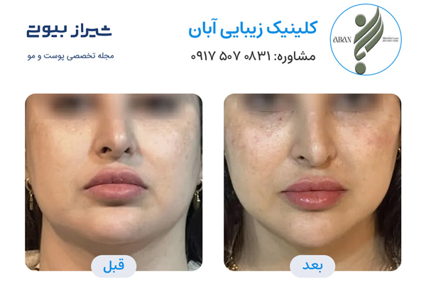 تزریق ژل در شیراز - کلینیک آبان
