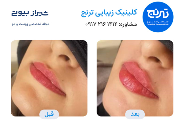 تزریق ژل در شیراز - کلینیک ترنج