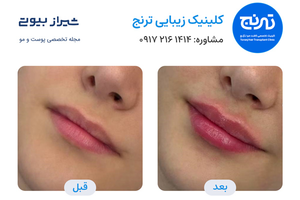 تزریق ژل در شیراز - کلینیک ترنج