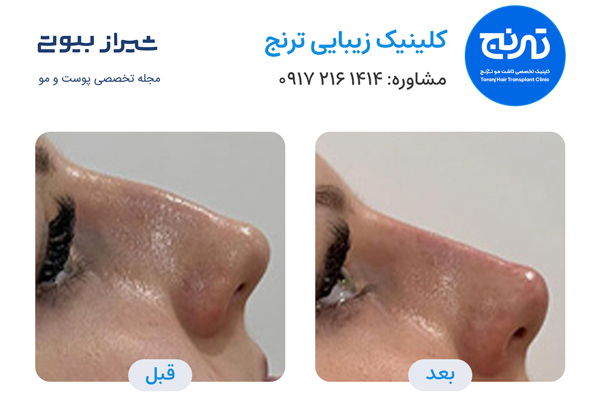 تزریق ژل در شیراز - کلینیک ترنج
