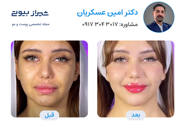 تزریق ژل در شیراز - دکتر امین عسکریان