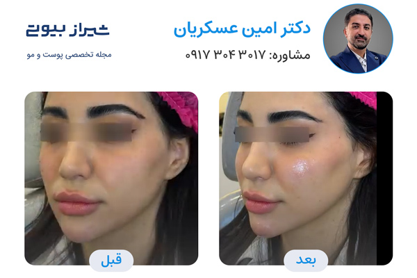 تزریق ژل در شیراز - دکتر امین عسکریان