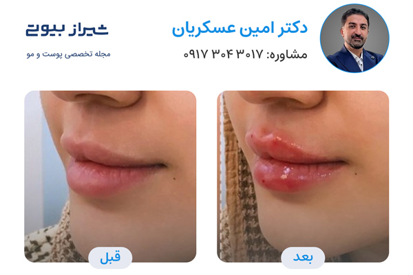 تزریق ژل در شیراز - دکتر امین عسکریان
