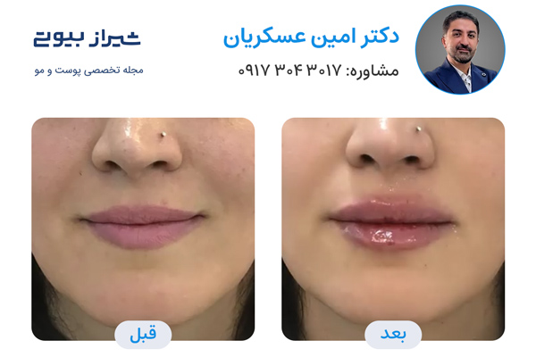 تزریق ژل در شیراز - دکتر امین عسکریان