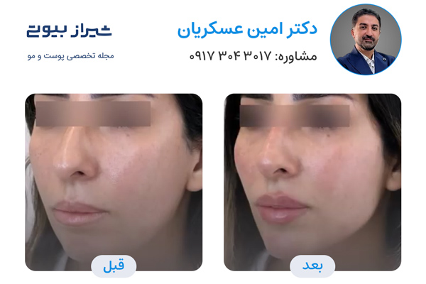 تزریق ژل در شیراز - دکتر امین عسکریان
