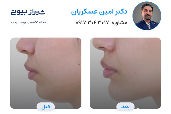تزریق ژل در شیراز - دکتر امین عسکریان