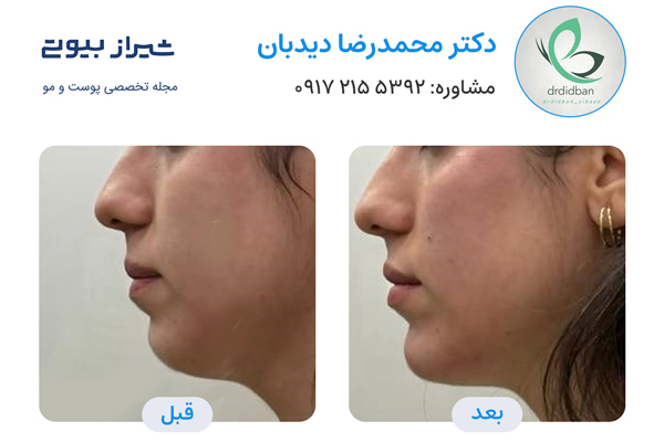 تزریق ژل در شیراز - دکتر محمدرضا دیدبان