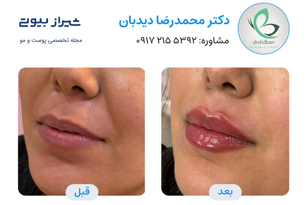 تزریق ژل در شیراز - دکتر محمدرضا دیدبان