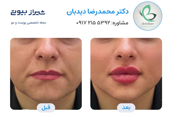 تزریق ژل در شیراز - دکتر محمدرضا دیدبان