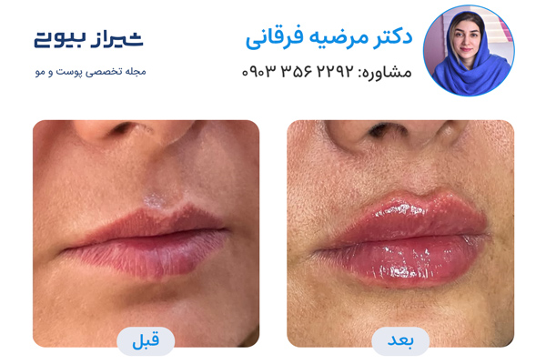 تزریق ژل در شیراز - دکتر مرضیه فرقانی