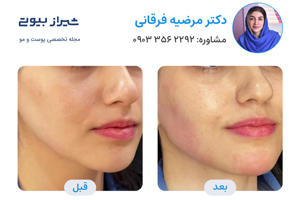 تزریق ژل در شیراز - دکتر مرضیه فرقانی