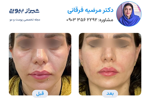تزریق ژل در شیراز - دکتر مرضیه فرقانی
