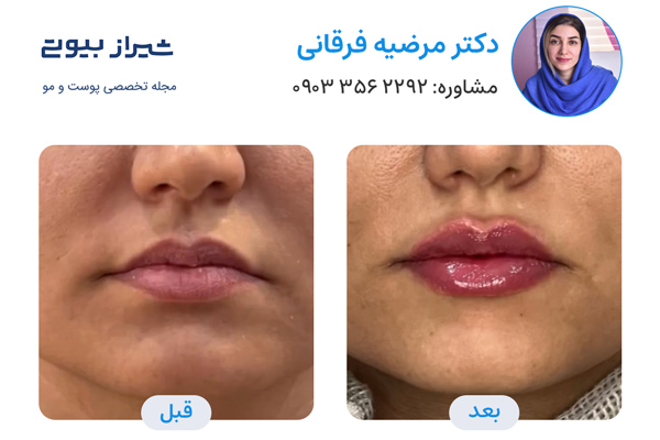 تزریق ژل در شیراز - دکتر مرضیه فرقانی