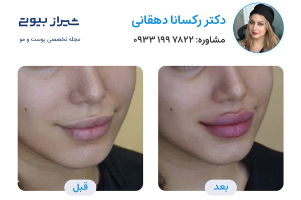 تزیرق ژل در شیراز - دکتر رکسانا دهقانی نمونه کارقبل و بعد