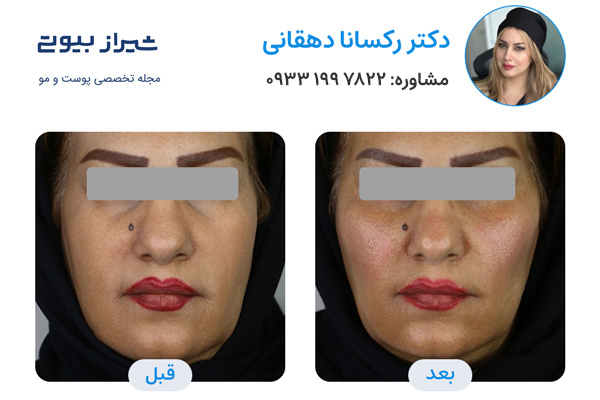 تزیرق ژل در شیراز - دکتر رکسانا دهقانی نمونه کار قبل و بعد