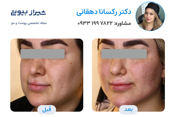 تزیرق ژل در شیراز - دکتر رکسانا دهقانی نمونه کار قبل و بعد