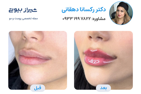 تزیرق ژل در شیراز - دکتر رکسانا دهقانی نمونه کار قبل و بعد