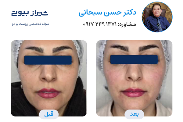 تزریق ژل در شیراز - دکتر حسن سبحانی