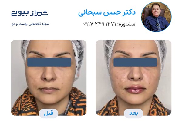 تزریق ژل در شیراز - دکتر حسن سبحانی