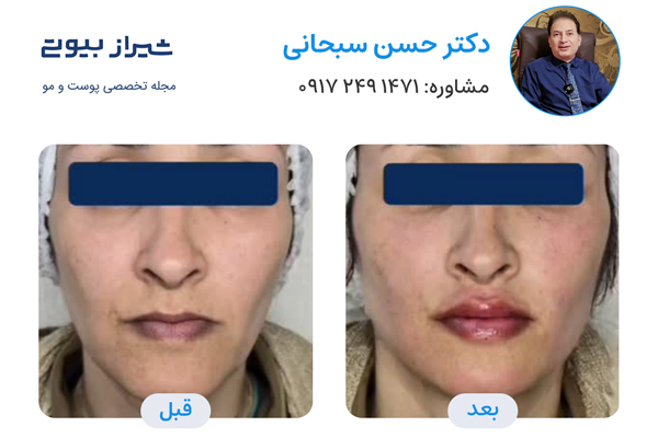 تزریق ژل در شیراز - دکتر حسن سبحانی